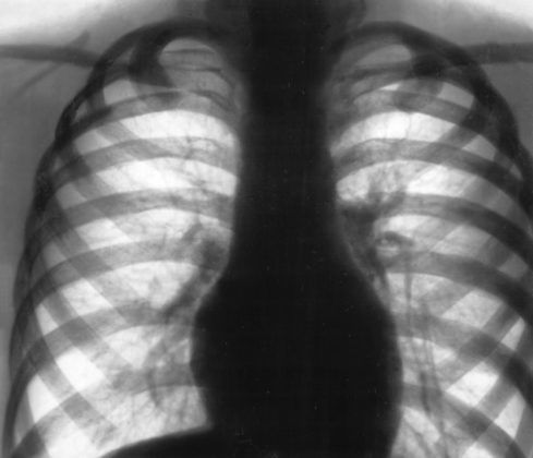 Що таке дифузний пневмофіброз легенів і як його лікувати