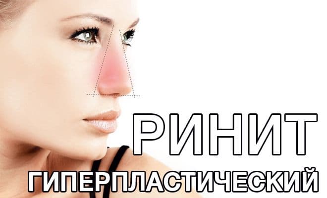 Що таке гіперпластичний риніт – симптоми і лікування 2019