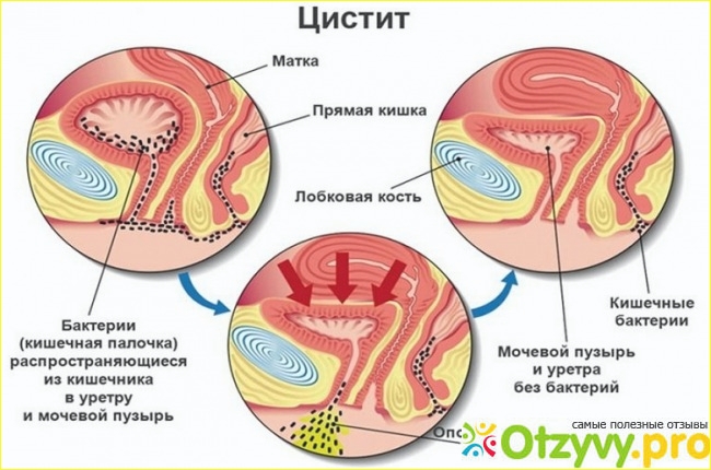 СЕКСТАФАГ ПРИ ЦИСТИТІ відгуки лікарів негативні і реальні, розлучення чи правда, ціна в аптеці на 2019 14:44