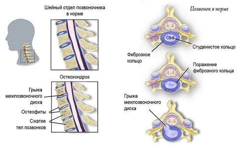 Шийний остеохондроз як лікувати в домашніх умовах