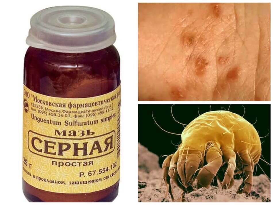 Швидке лікування корости в домашніх умовах народними засобами