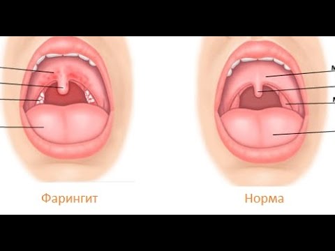 Симптоми субатрофического фарингіту і методи лікування