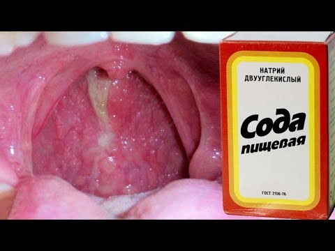 Симптоми субатрофического фарингіту і методи лікування