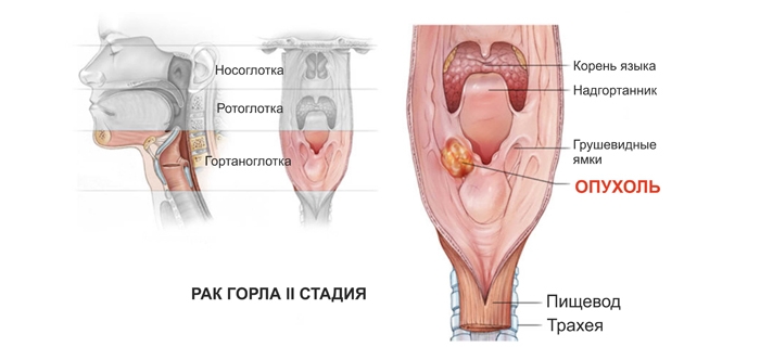 Симптоми та ознаки раку горла і гортані у жінок на ранніх стадіях