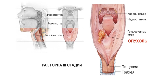 Симптоми та ознаки раку горла і гортані у жінок на ранніх стадіях