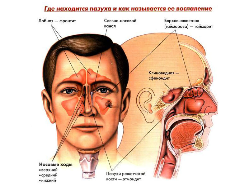 Синусит у дітей причини симптоми і лікування захворювання