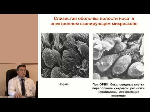 Синусит: види і причини синуситу, симптоми і лікування