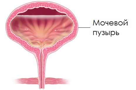 Сода при циститі у жінок: інструкція по застосуванню