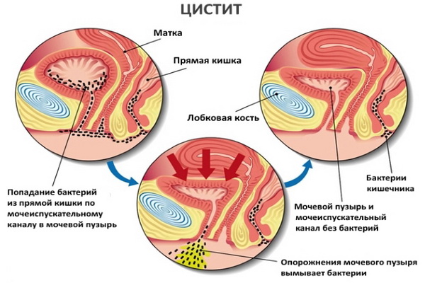 Сода при циститі у жінок: інструкція по застосуванню