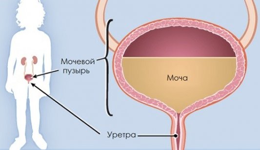 Способи виявлення та лікування лейкоплакії сечового міхура