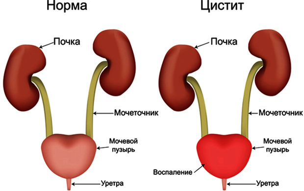 Спринцювання при циститі – Цистит, Лікування циститу народними засобами