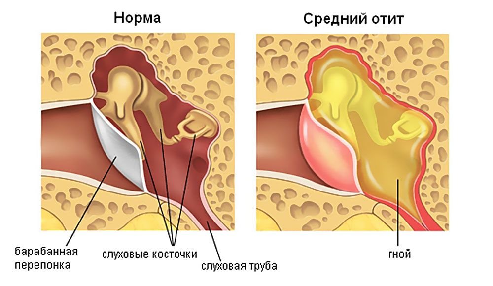Страшна операція на вусі при отиті