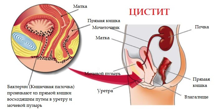 Таблетки Бісептол при циститі