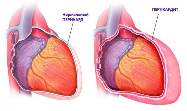Тахікардія – лікування народними засобами