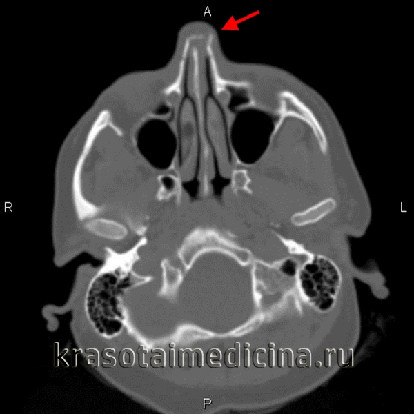 Травми носа причини симптоми і лікування