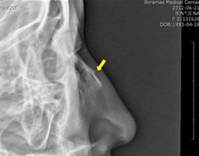 Травми носа причини симптоми і лікування