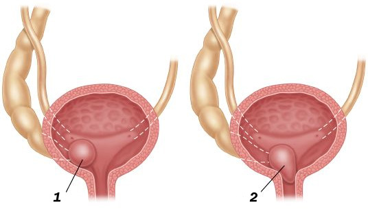 Уретероцеле сечового міхура у жінок і дітей