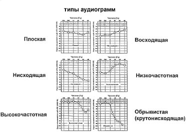 Види аудіометрії слуху