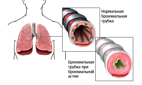 Види і типи бронхіальної астми