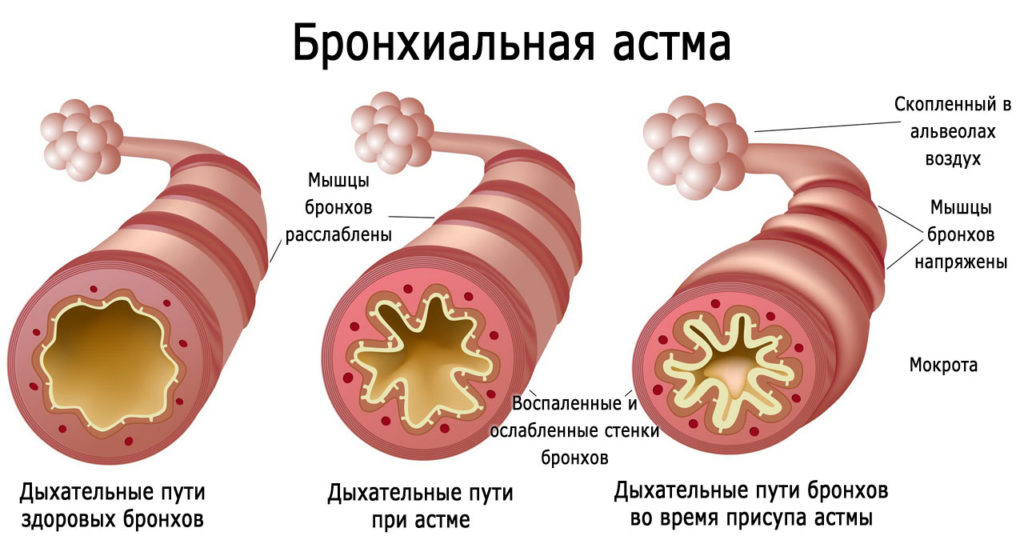 Види і типи бронхіальної астми