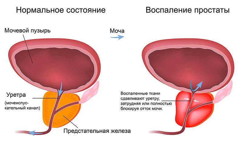 Які аналізи потрібно здавати при циститі