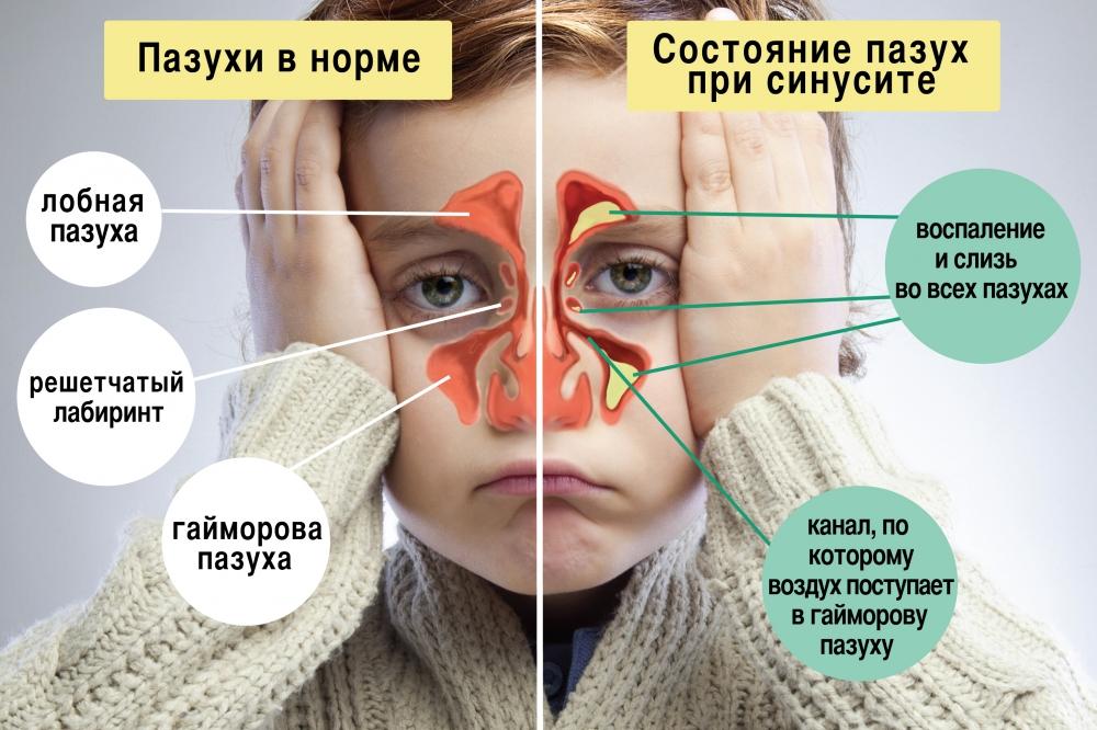 Які антибіотики приймати в таблетках при гаймориті у дорослих