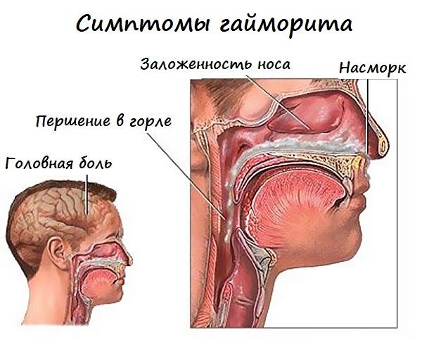 Які антибіотики приймати в таблетках при гаймориті у дорослих