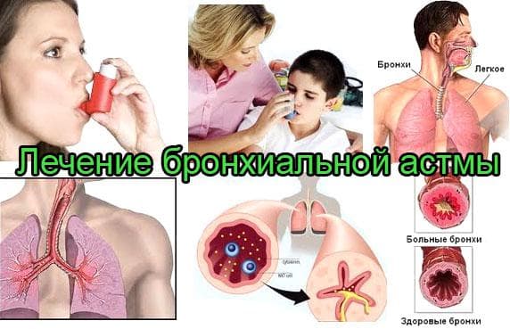 Як лікувати астму народними засобами?