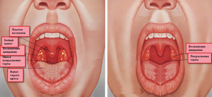 Як не пропустити перші симптоми гнійного фарингіту і швидко його вилікувати