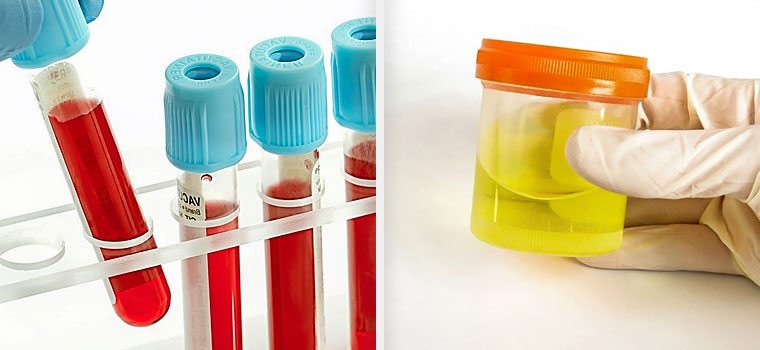 Які потрібно здати аналізи для циститу
