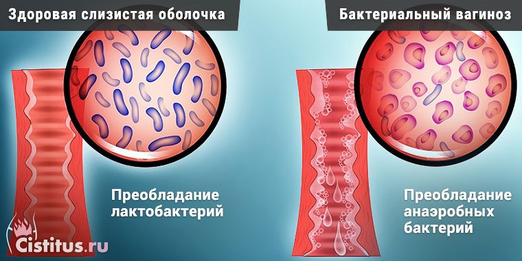 Як роблять мазок на бактеріальний вагіноз