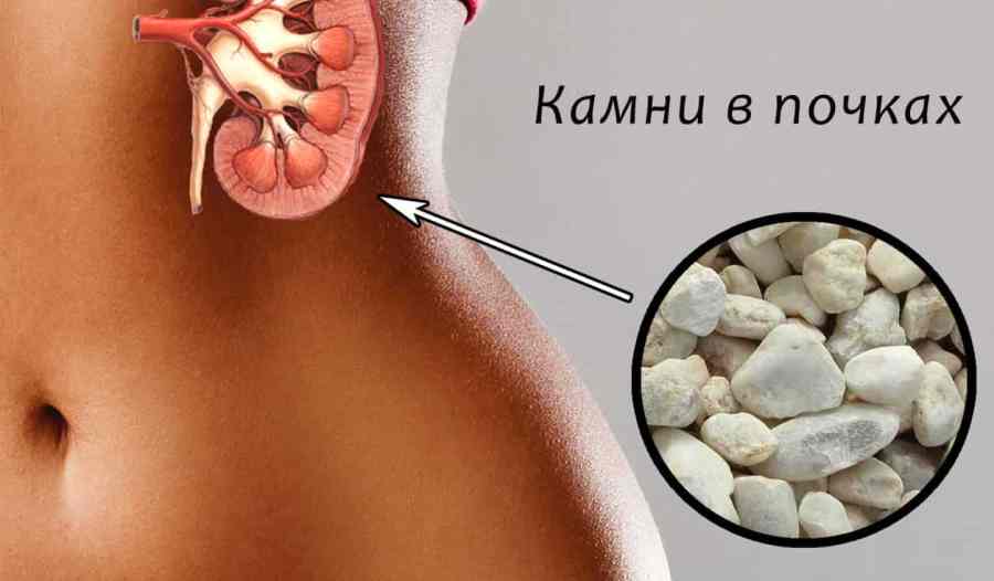 Як розчинити камені в нирках народними засобами Нирки