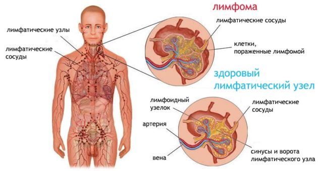 Як розпізнати пухлини носа і приносових пазух