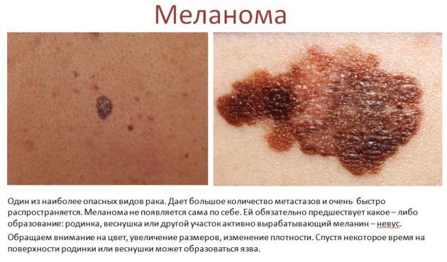 Як розпізнати пухлини носа і приносових пазух