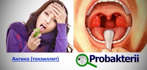 Як відрізнити вірусну інфекцію від бактеріальної