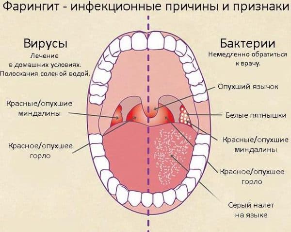 Як вилікувати хронічний тонзиліт при вагітності без наслідків для плода