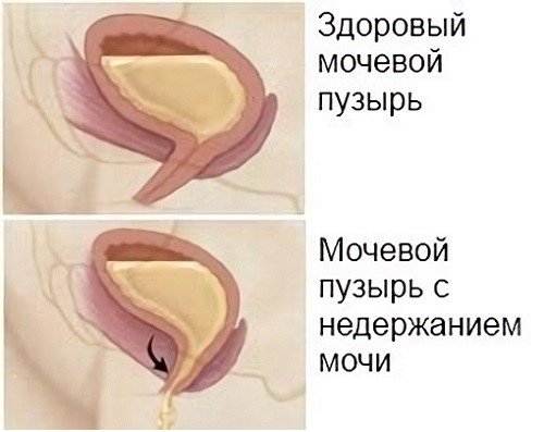 Як вилікувати нетримання сечі при циститі
