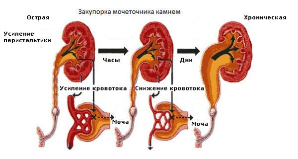 Як вилікувати нетримання сечі при циститі