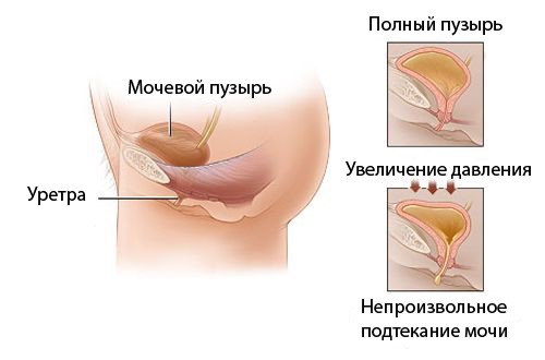 Як вилікувати нетримання сечі при циститі