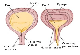 Як вилікувати нейрогенний сечовий міхур