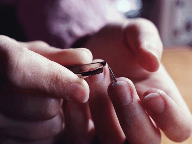 Як витягти скалку в домашніх умовах. Як можна витягти скалку, якщо вона глибоко. Заноза під нігтем — що робити. Як витягти скалку у дитини без голки