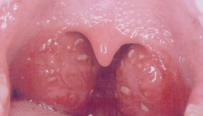 Як застосовувати Ацикловір при ангіні Як застосовувати Ацикловір при ангіні