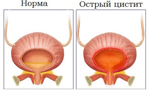 Як заварити шипшину від циститу
