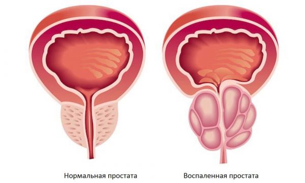 Запалення сечового міхура у чоловіків симптоми і лікування