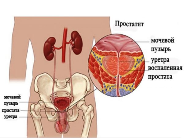 Заразний цистит як передається це захворювання