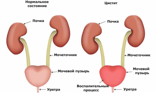 Заразний цистит як передається це захворювання