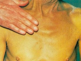 Жовтяниця у дорослих і дітей. Народні методи лікування