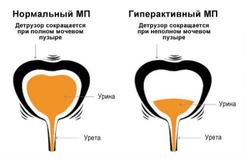 Зниження гіпоксії детрузора сечового міхура