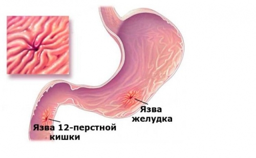 Дієта при виразці