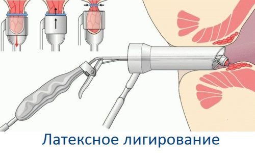 Коли призначається і як проходить лігування гемороїдального вузла?
